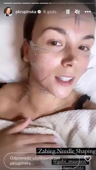 Paulina Krupińska na zabiegu akupunktury twarzy 