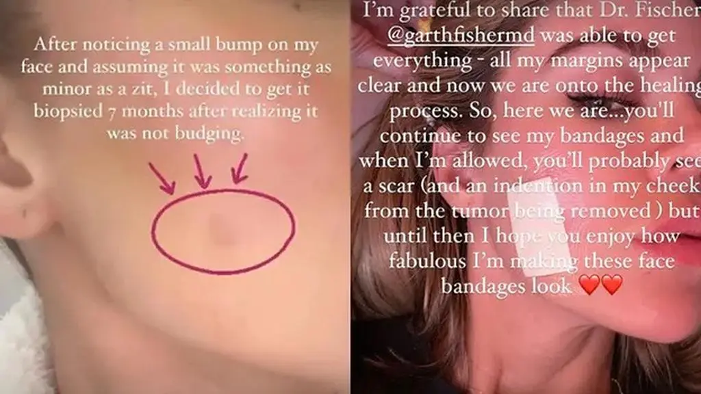 Khloe Kardashian przeszła biopsję
