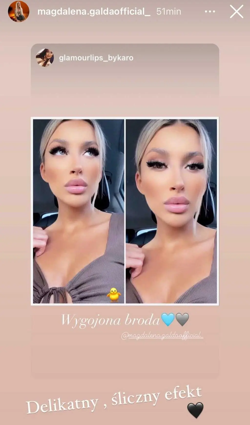 Magda z "HP" pokazała, jak wygląda jej twarz po zabiegu