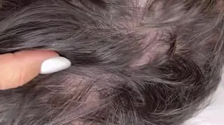 Rafał Maślak przed przeszczepem włosów