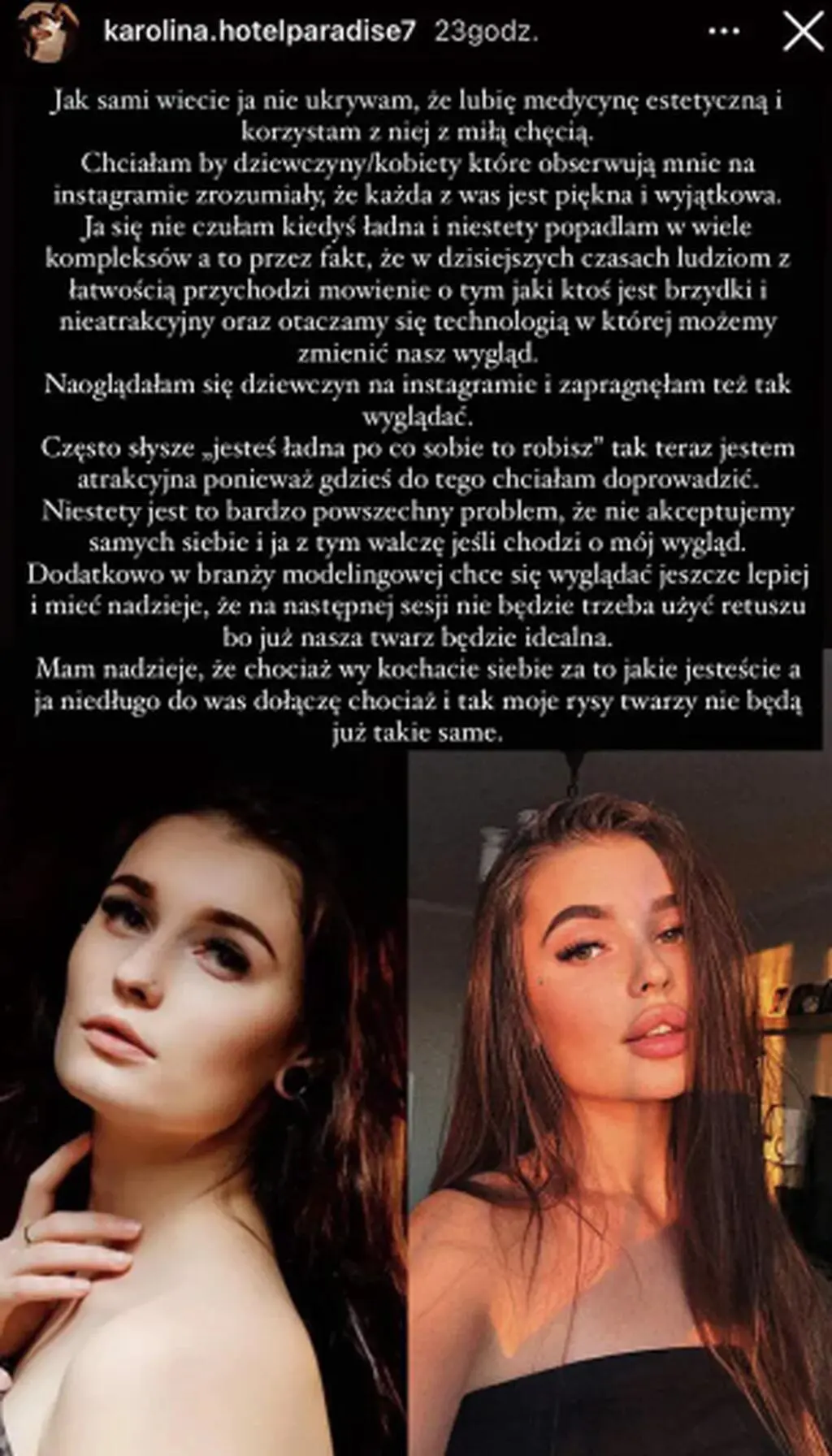 "Hotel Paradise". Karolina "Mallu" Majewska pokazała, jak wyglądała przed zabiegami medycyny estetycznej