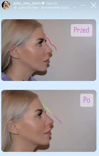 Julia von Stein przeszła operację nosa