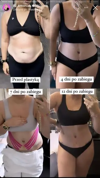 Lili Antoniak pokazała brzuch po zbiegu