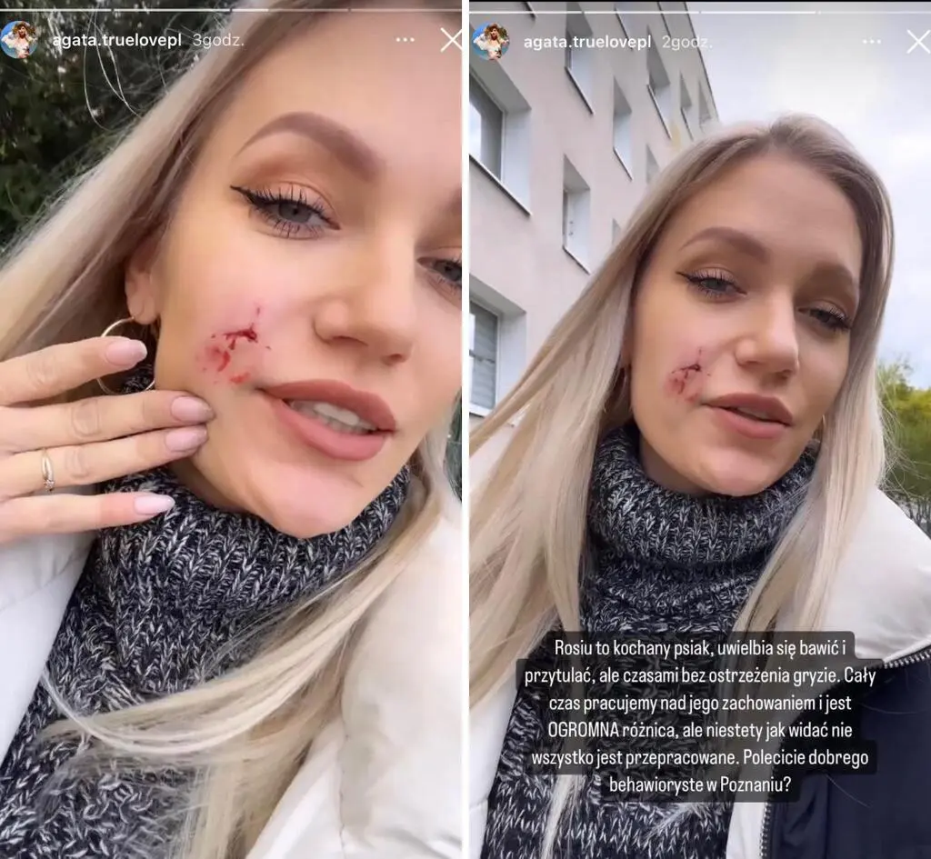 Agata z "TL" została pogryziona przez psa. Uczestniczka prosi o pomoc
