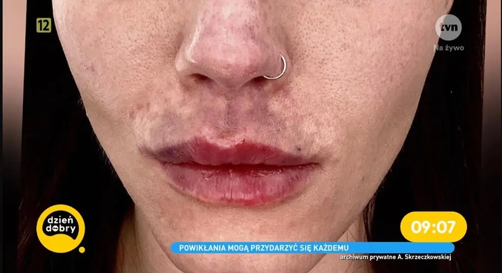 Agnieszka Skrzeczkowska z "Top Model" miała martwicę