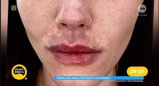 Agnieszka Skrzeczkowska z "Top Model" miała martwicę