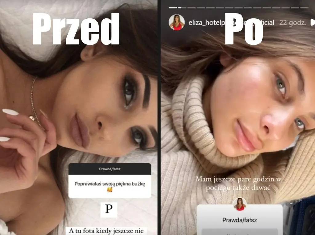 "Hotel Paradise". Eliza przed i po zabiegach