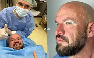 Tomasz Oświeciński po zabiegu medycyny estetycznej