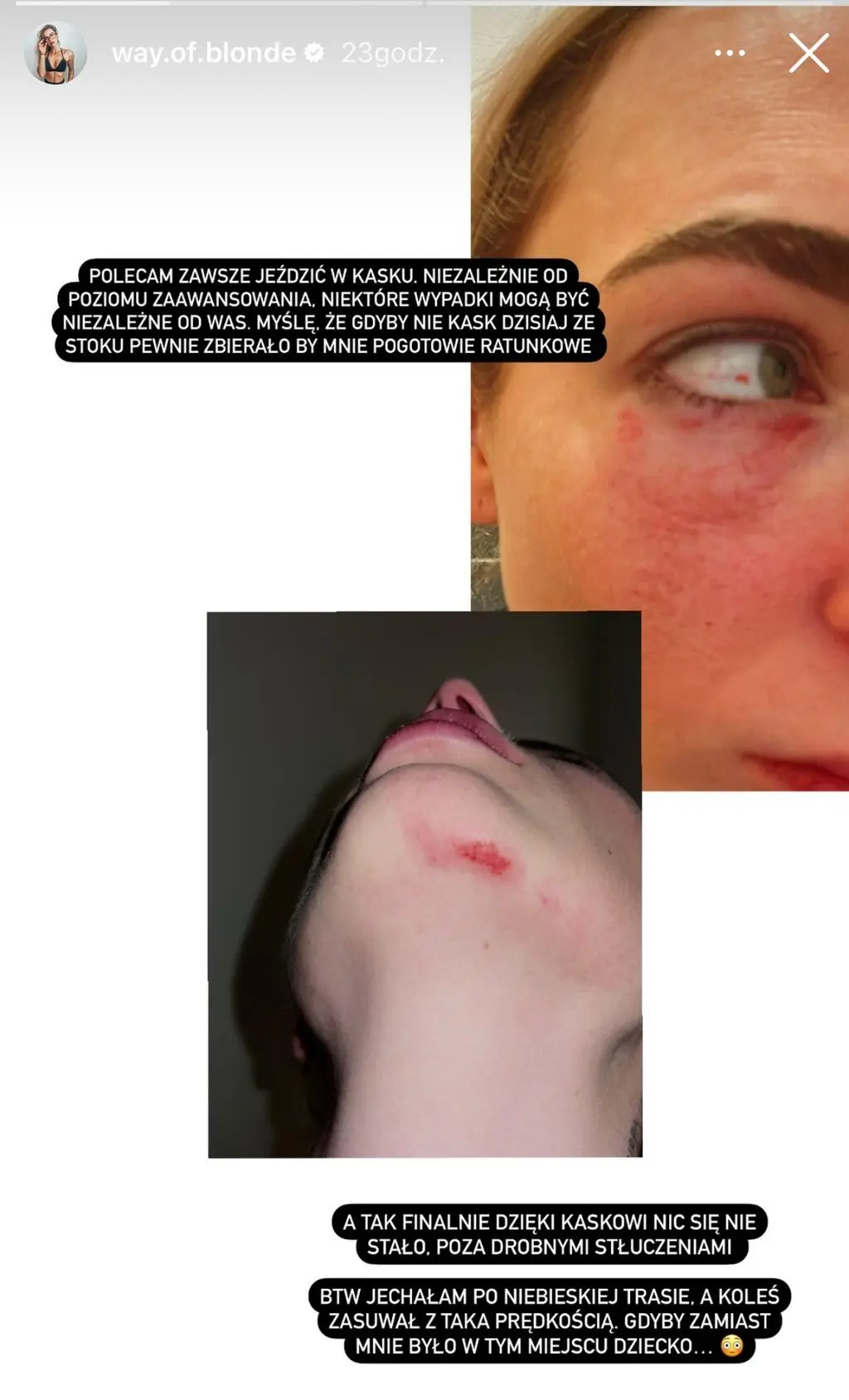 Karolina Brzuszczyńska podzieliła się zdjęciami obrazującymi obrażenia 