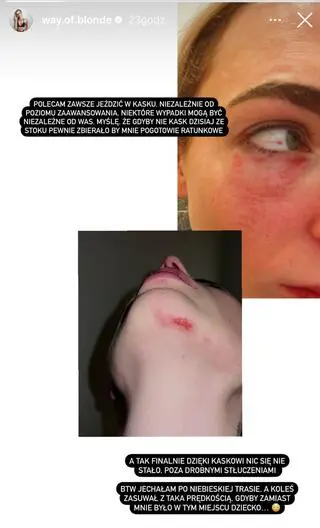 Karolina Brzuszczyńska podzieliła się zdjęciami obrazującymi obrażenia 