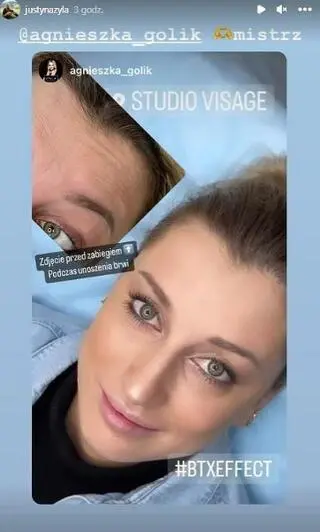 Justyna Żyła pokazała, jak wygląda jej czoło po botoksie