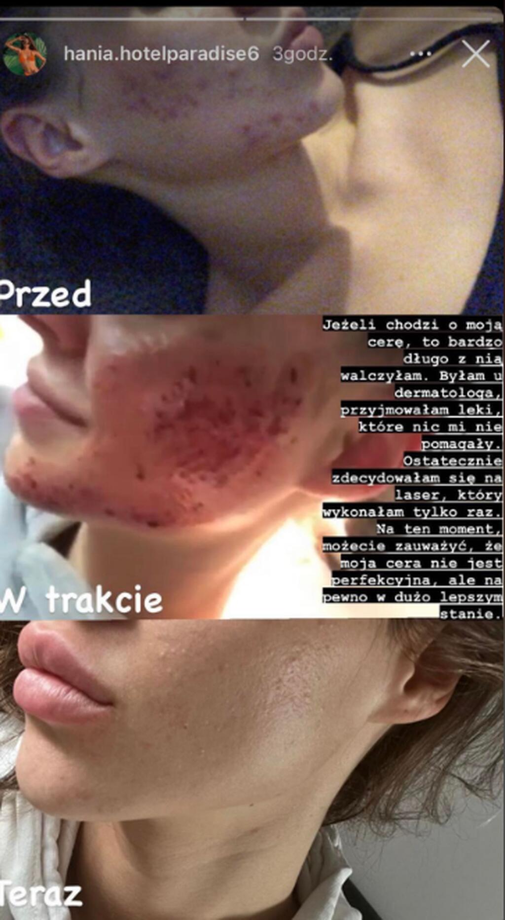 Hania z "HP" stała się inspiracją dla wielu osób. Pokazała proces walki o wymarzoną cerę